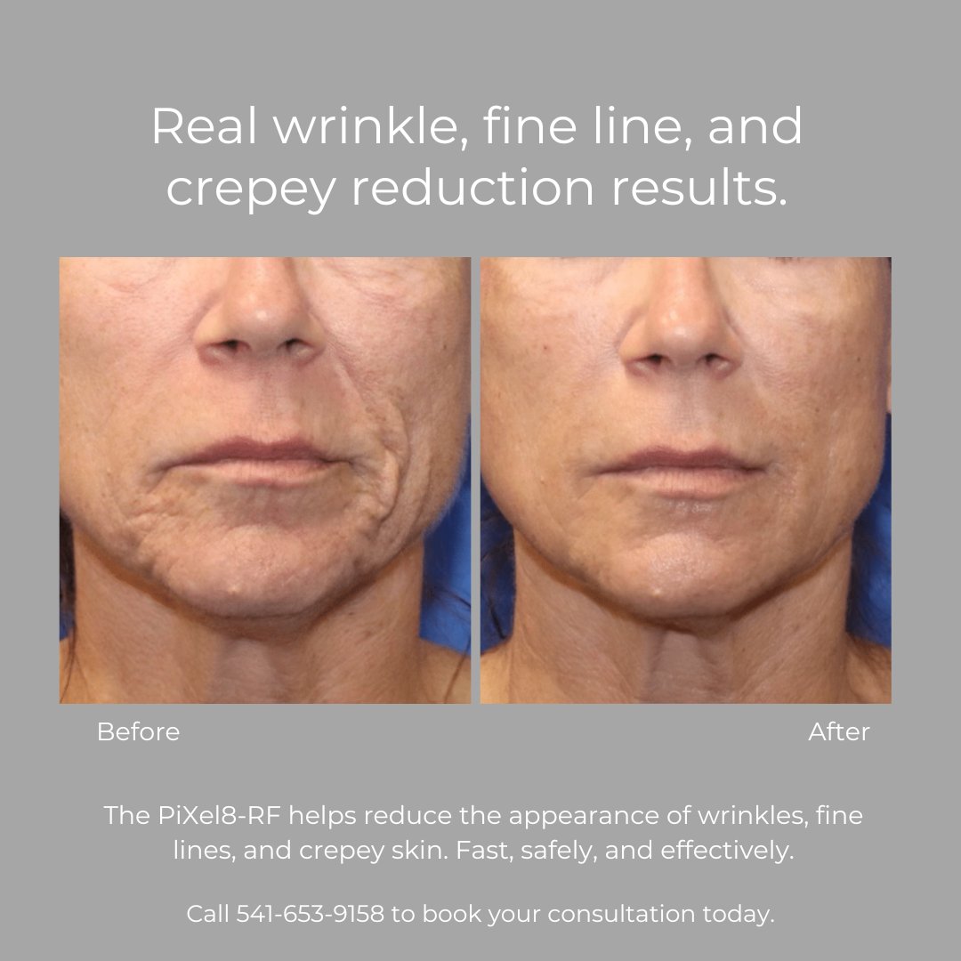 Pixel Rf Microneedling Willow Health And Aesthetics