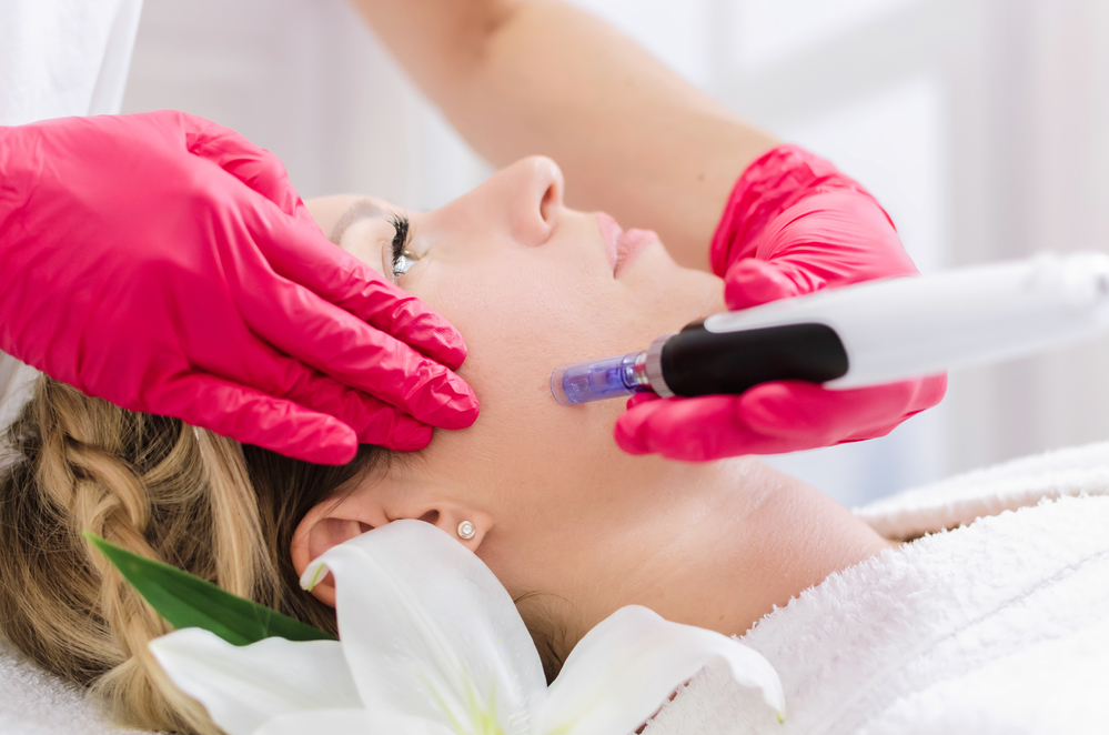 Microneedling Treatment At Willow Health And Aesthetics Willow Health